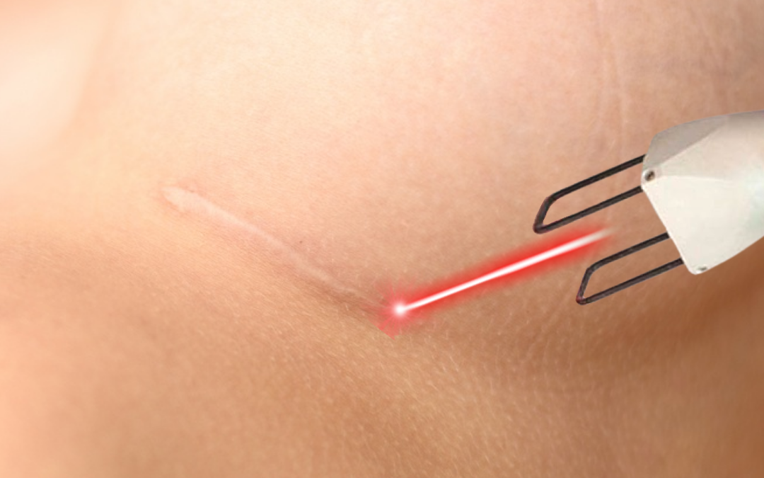 Laser CO2 Fracionado: Tratamento na Cicatriz da Mastopexia
